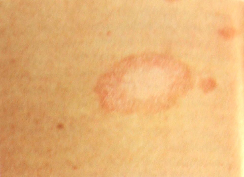 Red spots on skin not itchy - Diseases List